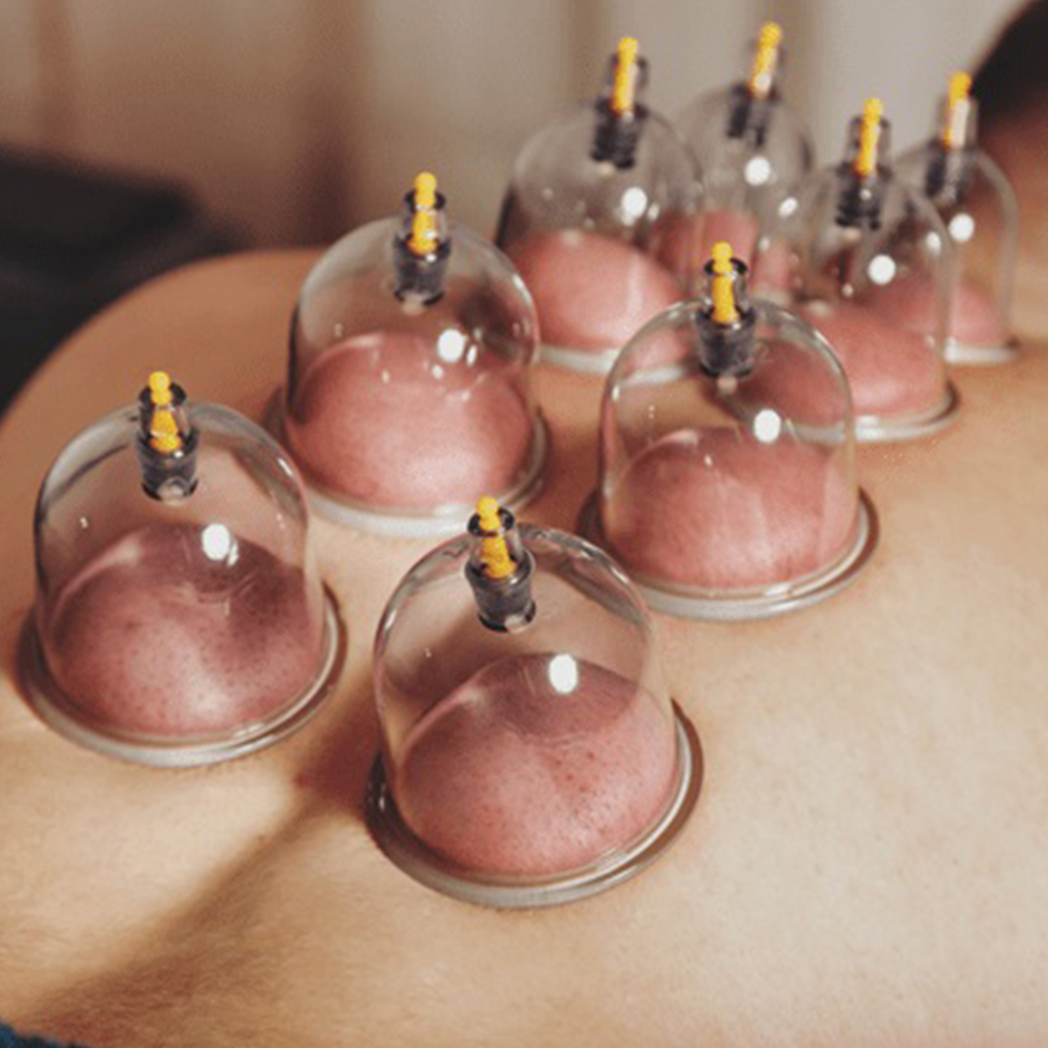 Cupping Therapy